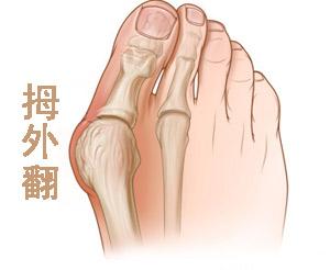 得了拇外翻之后有哪些症状?